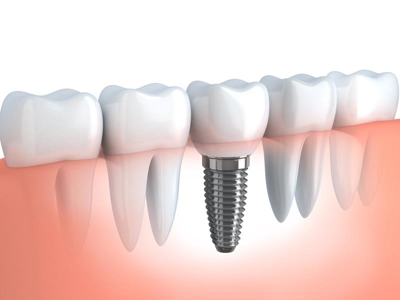 Dental Implants  Hamilton, NJ 